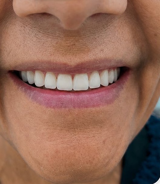 Prótese total (dentadura) - Depois